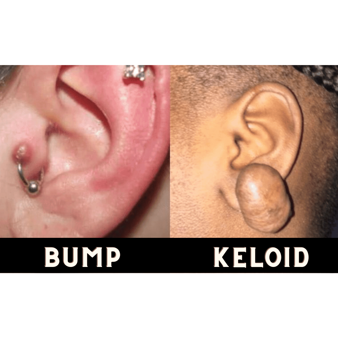 the differance between piercing Bumps and Keloids – Riri accessory